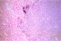 圖3：腎臟正常組織與腫瘤組織間之出血帶。