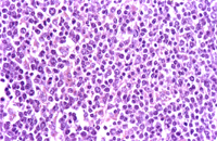 圖4：在高倍下可見腫瘤細胞藍染或淡染，細胞大小不一外型由卵圓型到多邊型，核質比高，質呈淡藍，偶爾可見有絲分裂相。 