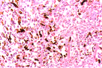 圖1：腎臟於皮質部可見密發大小不一圓型或斑狀外圍紅色中間淡紅之結節病變。