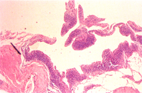 圖3:關節之滑液膜組織切片可見許多增生之組織及淋巴球浸潤