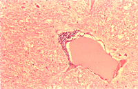 圖4:腦脊髓組織切片,呈非化膿性腦脊髓炎病變。