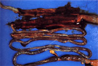 圖3：腸管剪開可見腸腔內含有大量黑紅色之粘液。