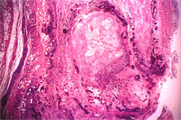 圖2：關節滑膜結締組織大量增生, 新血管生成及一膿瘍病灶之形成, 高倍鏡下並可見大量嗜中性球及單核球浸潤。