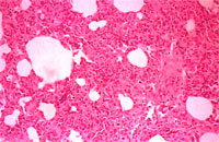 圖3:肺臟間質細胞明顯增生, 間質部並可見粉紅色均質樣物之沉積及少量融合細胞之形成。