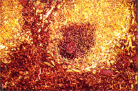 圖4:脾臟馬氏小體周圍有大量粉紅色均質樣物質沉澱。經剛果紅染色(Congo red stained)及偏光鏡檢查, 呈淡綠色螢光。因此判定為Amyloid物質。