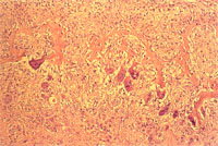 圖3：骨質之組織病變, 可見大量的纖維結締組織取代原有之骨組織, 骨小樑變稀少。