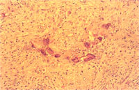 圖4：高倍鏡下可見多數之多核巨細胞樣結構之蝕骨細胞及大量增生的結締組織。