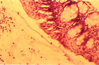 圖4：眼窩下竇400 X。鏡下可見粘膜上皮層之杯狀細胞增生, 腔內有多量Pilar-form 原蟲蓄積於纖維素炎症液中, 伴隨有多量異嗜球的浸潤。
