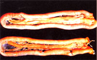 圖3：胰臟。罹病雞之胰臟明顯皺縮和小腸之間有層薄膜間隔。