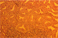 圖4：腺胃之腺體部三級排泄管呈高柱狀上皮細胞狀，且見腺管間有淋巴細胞聚集呈瀘泡樣。H & E stain, 200 X