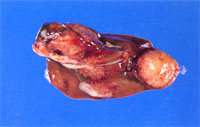 圖2：肝臟側面同樣可見黃褐色之斑塊，病灶深入肝實質中。