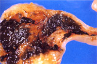 圖3：盲腸肥厚腫大，剖開後可見多數白色之盲腸蟲