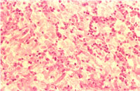 圖4：腸管之壞死區內可見多數紅染的球狀原蟲, 在這些間隙並有巨噬細胞、淋巴球、漿細胞, 各原蟲有一個淡紅色的核。 
