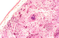 圖8：住血原蟲性白冠病後期組織病變不見蟲體， 僅見不同層次之慢性炎症， 類症鑑別需特別注意