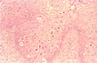 圖4： 肉垂組織切片： 局部潰瘍，上皮細胞增生呈氣球樣變性。於增生變性之上皮細胞質可見多數大小不一嗜酸性質內包涵體。
