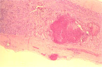 圖3：腸管環狀帶之深層潰瘍灶。