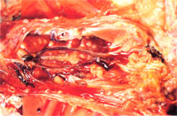 圖3： 腎臟之多發黃白色結節。