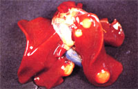 圖5： 肝臟之多發黃白色結節。
