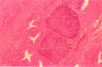 圖8： 華氏囊有淋巴母細胞浸潤、發育不全及囊狀物形成。 