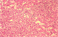 圖2： 肝臟， 低倍下可見許多骨髓球細胞浸潤。