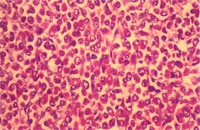 圖3： 肝臟， 高倍下可見骨髓球具有偏於一邊的vesicular nucleus， 且其細胞質有很多嗜酸性顆粒。