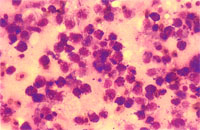 圖4： 腫瘤抹片，以Giemsa stain染色後可見腫瘤細胞的細胞質有許多紅色顆粒。