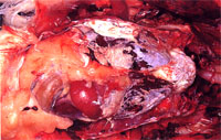 圖1：病禽之胸腹腔臟器漿膜面上滿佈粉筆灰狀白色粉末，此為尿酸鹽類之結晶。