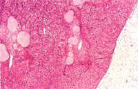 圖3： 腎低倍下可見許多囊腔狀構造，疑似其中為尿酸鹽聚積處，於組織切片過程中被水所溶解，而遺留下腔洞。H & E, 20X