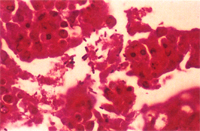 圖5： 病理組織切片於高倍相， 腸上皮細胞內可見球蟲蟲體，上皮細胞及管腔內壞死脫落上皮細胞聚集處可見許多長桿菌。H & E, 1000 X