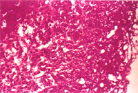 圖6： 病理組織切片下，肝臟多發局部壞死灶，肝竇狀隙有Trophozoites等不同生長時期之球蟲蟲體。H & E, 200 X