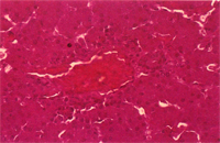 圖7： 肝臟門靜脈區周圍可見許多單核炎症細胞浸潤。H & E, 400 X