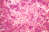 圖3： 棒狀桿菌症，上圖高倍，組織結構已無法分辨，但可見嗜鹼性，聚集成群之菌落，纖維素性壞死碎片，巨噬細胞圍繞。