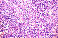 圖4： 黴漿菌症，肺臟，同上圖高倍，增生之細胞以淋巴球，巨噬細胞及少量漿細胞為主。