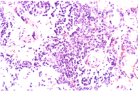圖5： 黴漿菌症，肺臟，圍小血管淋巴細胞浸潤。