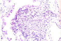 圖6： 黴漿菌症，肺臟，圍小支氣管淋巴組織增生及上皮細胞扁平化生。   