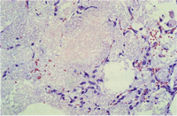 圖3： 高倍所見泡沫狀顆粒樣物質。
