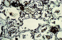圖4：肺囊蟲症，GMS染色；肺泡腔內有許多呈陽性黑色，球形，直徑2～6µ物質。