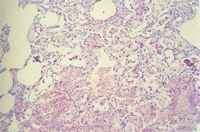 圖5：肺囊蟲症，PAS染色；肺泡細胞及肺泡腔中可見多發呈陽性粉紅色之物。