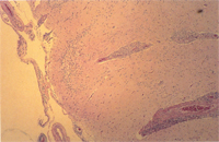 圖1：狗肉芽腫性腦膜脊髓炎，低倍圖(63 X)。慢性炎症細胞主要侵犯血管周圍，增生形成很厚的非化膿性肉芽腫性反應。 H & E stain