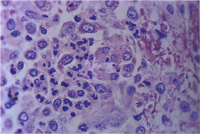 圖2： 狗肉芽腫性腦膜脊髓炎，高倍圖(800 X)。血管周圍非化膿性肉芽腫性炎症細胞為混合性，包括組織球、吞噬細胞、類上皮細胞、淋巴球、漿細胞及少許嗜中性球。 H & E stain。