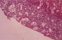 圖3： 小腸絨毛極度萎縮, 呈平坦狀, 且腺窩擴張, 腺窩上皮壞死脫落。H & E stain, 200 X