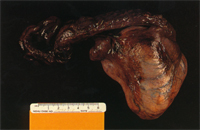 圖1：腫瘤之外觀，有精索附著，7.5×7.8×5.2立方公分，深褐色，表面大量血管分佈。