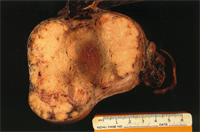 圖2： 腫瘤切面，呈白色微帶黃色，分葉明顯(結締組織小樑狀構造)，具有明顯中央之腫瘤壞死核心。