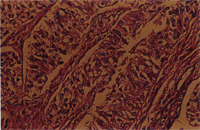 圖3： 鏡下生精小管之腫瘤細胞分佈於小管腔中，小管間有結締組織；腫瘤細胞呈長形且呈多角或長三角形，核長橢圓到卵圓形。H & E stain, 100 X