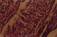 圖4： 高倍可見腫瘤細胞呈典型賽托利氏細胞之長三角形且質內有小空泡的形態。H & E stain, 400 X 