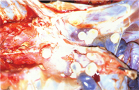 圖1： 剖檢可見胸腔表面及表囊均有白色火山口乾酪樣之突起結節。