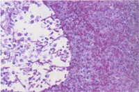 圖2： 肺臟組織切片可見多量分枝且分節之黴菌菌絲於壞死區內。