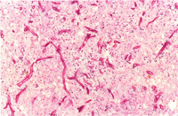 圖3： 病變區組織切片以PAS染色，可見多量分枝且分節之紅染黴菌菌絲。