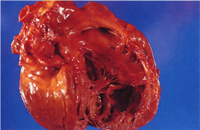 圖1： 右心室明顯擴大，三尖瓣呈疣狀突起。