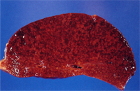 3. 肺：濕重潮紅，表面散發紅白相間之大理石花紋樣結構。 